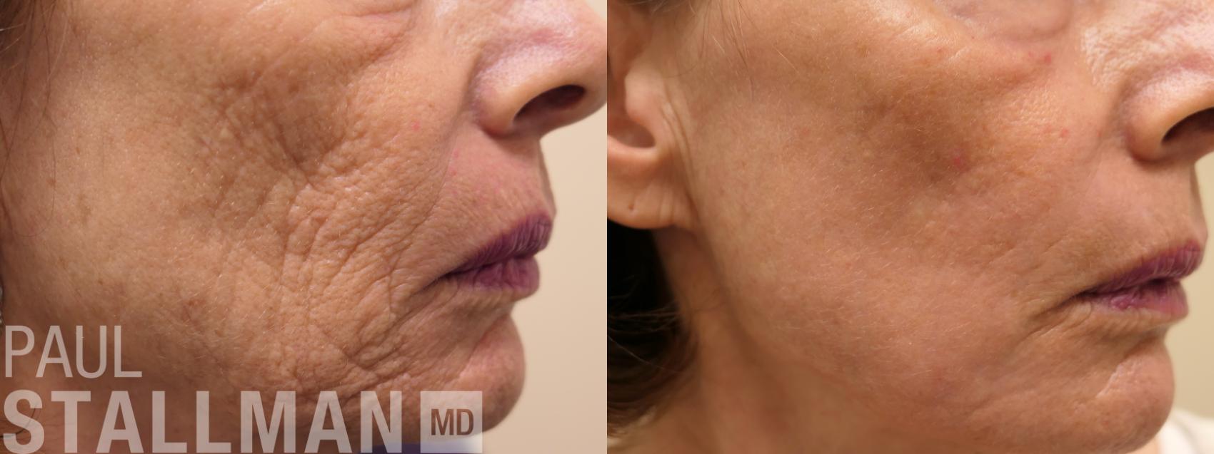 Before & After Laser Resurfacing Case 168 Right Side View in Fresno, Santa Maria, San Luis Obispo, CA