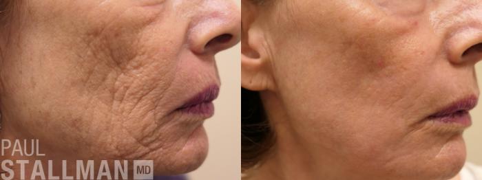 Before & After Laser Resurfacing Case 168 Right Side View in Fresno, Santa Maria, San Luis Obispo, CA