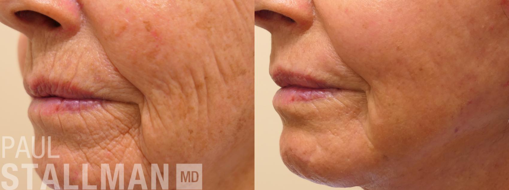 Before & After Laser Resurfacing Case 169 Left Side View in Fresno, Santa Maria, San Luis Obispo, CA