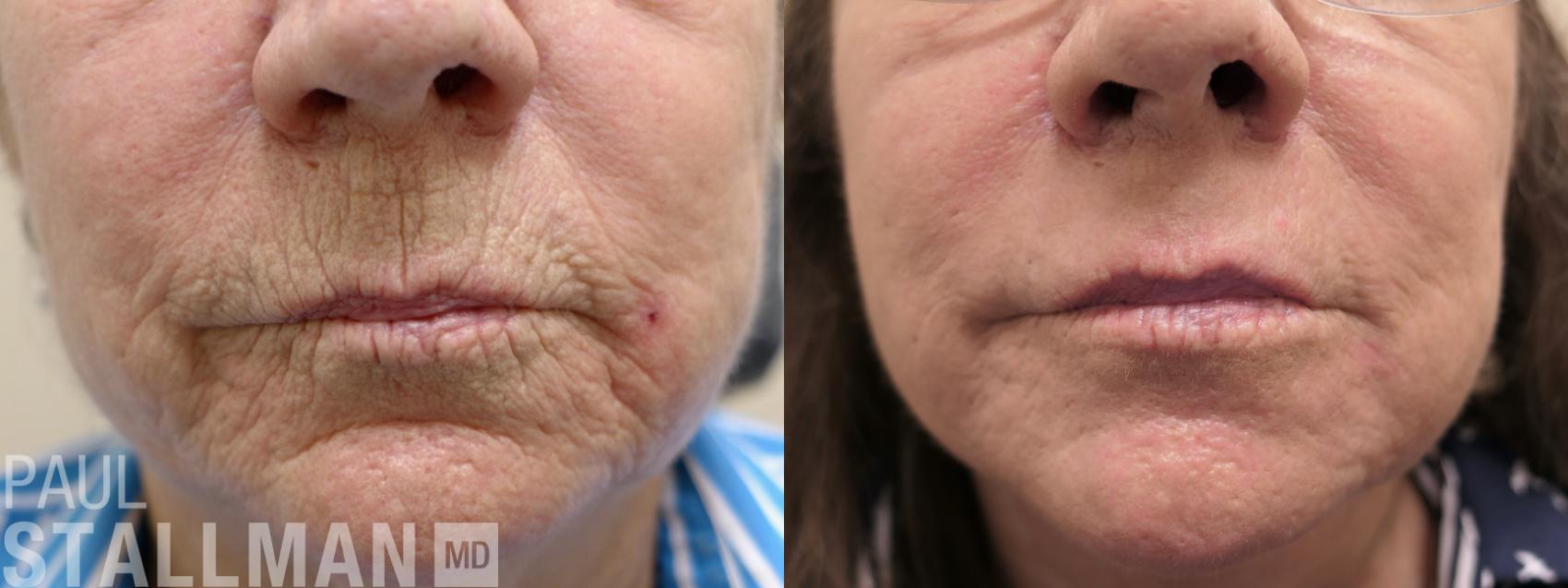 Before & After Injectable Fillers Case 170 Front View in Fresno, Santa Maria, San Luis Obispo, CA
