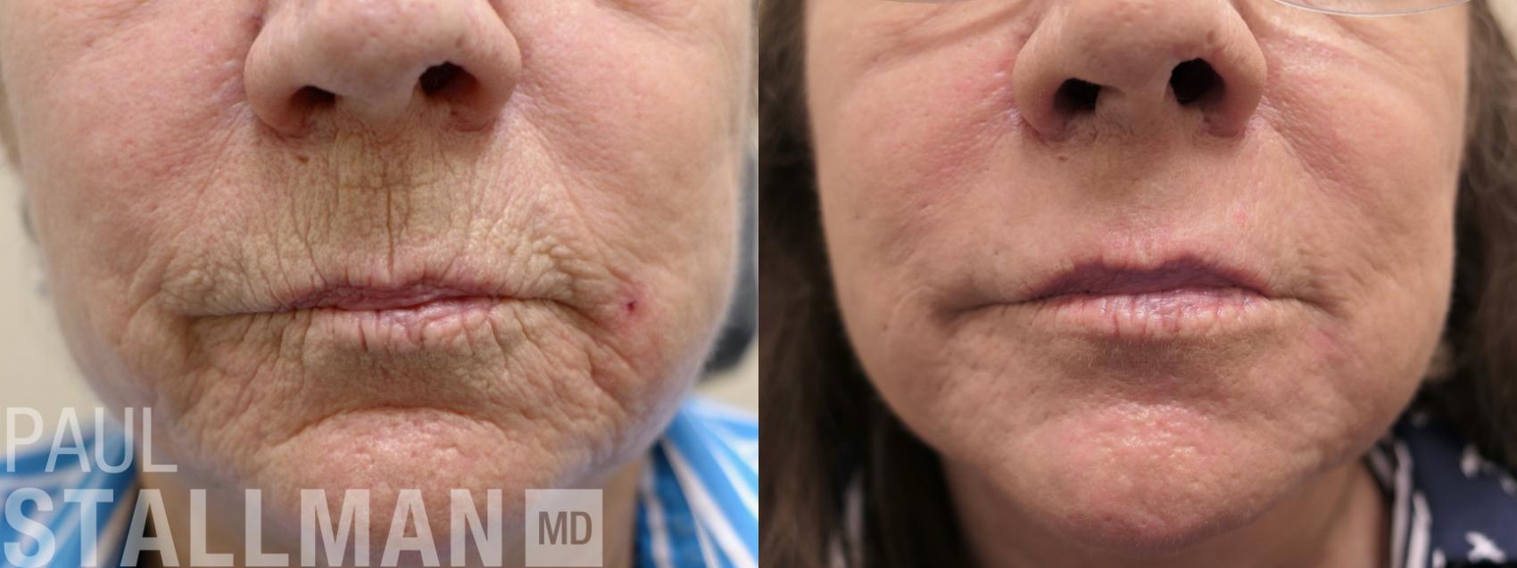 Before & After Injectable Fillers Case 170 Front View in Fresno, Santa Maria, San Luis Obispo, CA