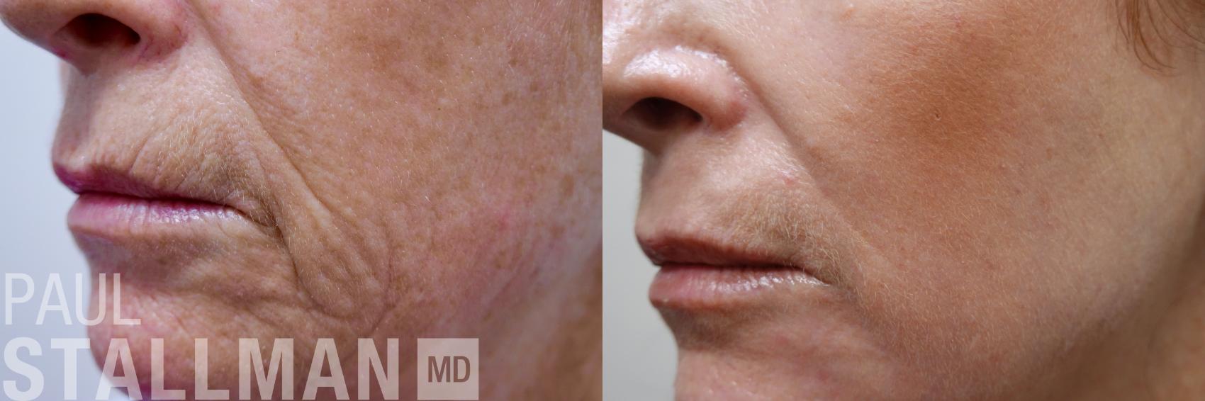 Before & After Injectable Fillers Case 172 Left Side View in Fresno, Santa Maria, San Luis Obispo, CA