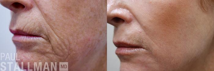 Before & After Injectable Fillers Case 172 Left Side View in Fresno, Santa Maria, San Luis Obispo, CA