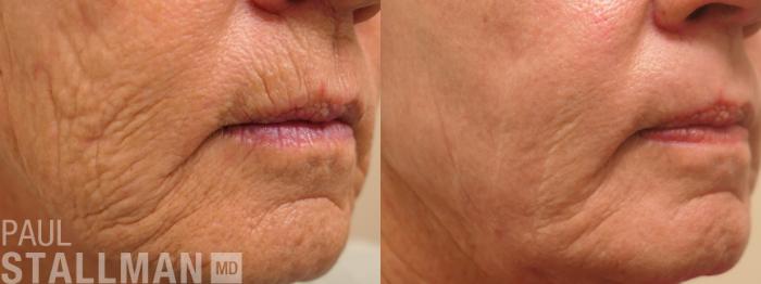 Before & After Laser Resurfacing Case 185 Right Side View in Fresno, Santa Maria, San Luis Obispo, CA