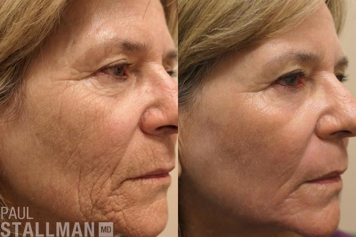 Before & After Laser Resurfacing Case 186 Right Side View in Fresno, Santa Maria, San Luis Obispo, CA