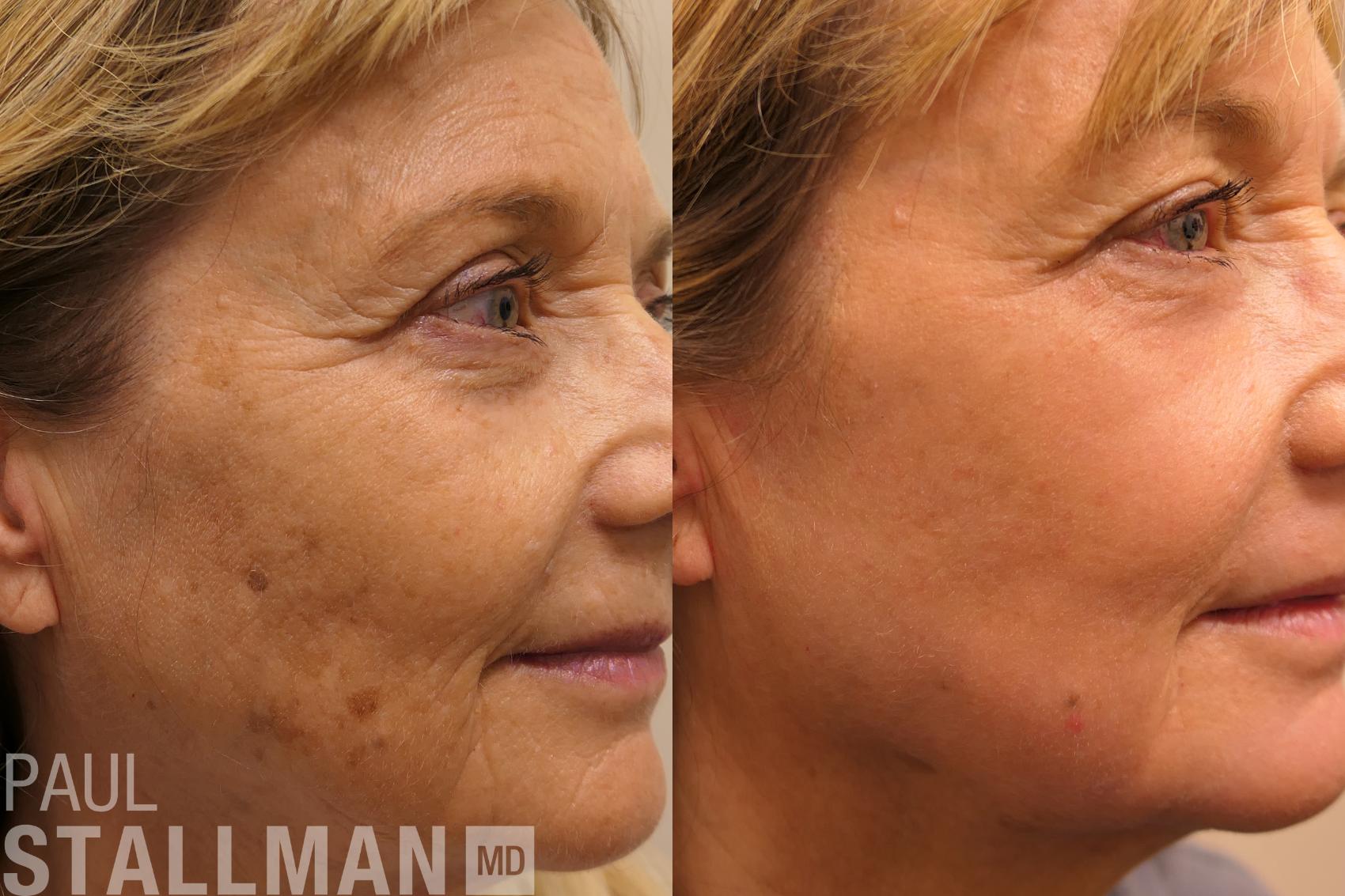 Before & After Laser Resurfacing Case 187 Front View in Fresno, Santa Maria, San Luis Obispo, CA