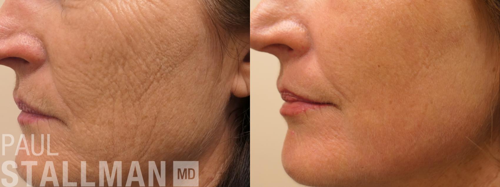 Before & After Laser Resurfacing Case 188 Left Side View in Fresno, Santa Maria, San Luis Obispo, CA