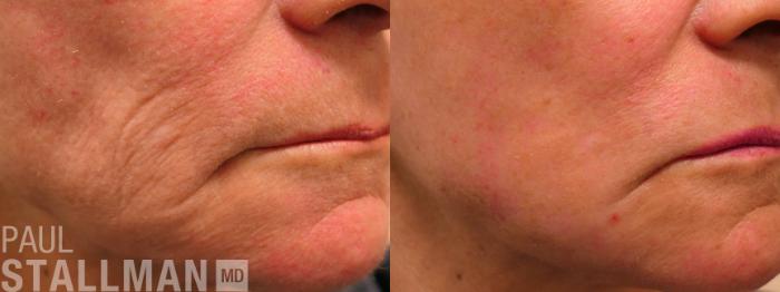 Before & After Laser Resurfacing Case 190 Right Side View in Fresno, Santa Maria, San Luis Obispo, CA