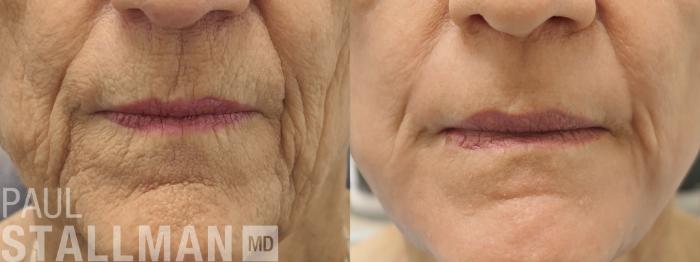 Before & After Laser Resurfacing Case 210 Front View in Fresno, Santa Maria, San Luis Obispo, CA